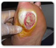 Prevención y tratamiento de las lesiones de pie diabético (2ª Edición)
